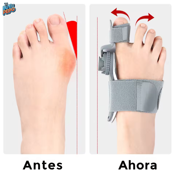 FeetiFix™ 🦶 - Alineador Ortopédico Para Juanetes 💪
